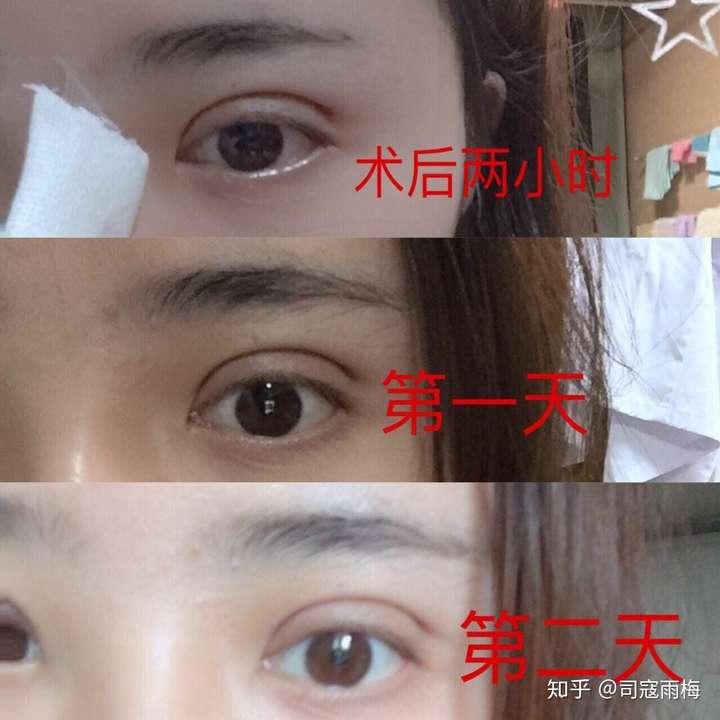 埋线双眼皮能持续多久?