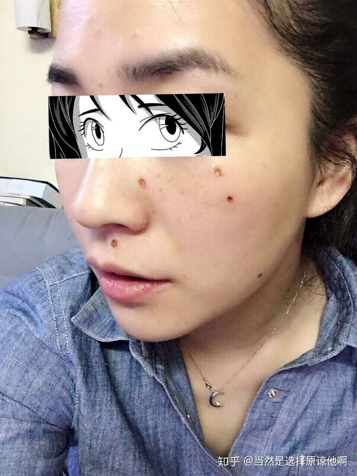 点痣后复发了是怎么回事