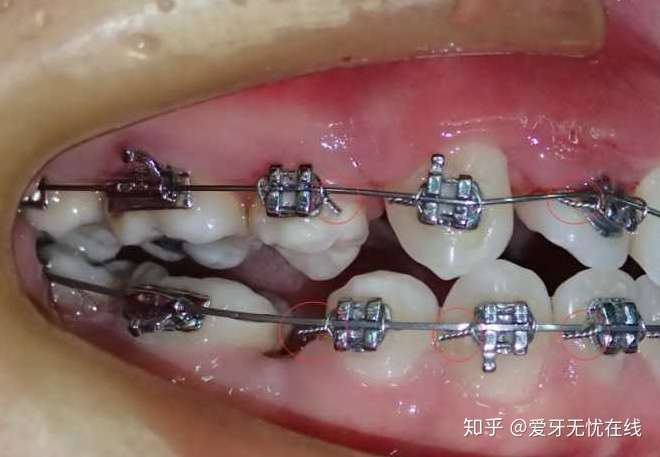 一,牙套种类 首先从大类上有两种:金属自锁牙套和金属非自锁 1.