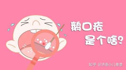 小儿推拿李波鹅口疮和奶垢的区别宝妈们可别弄混淆了注意这些