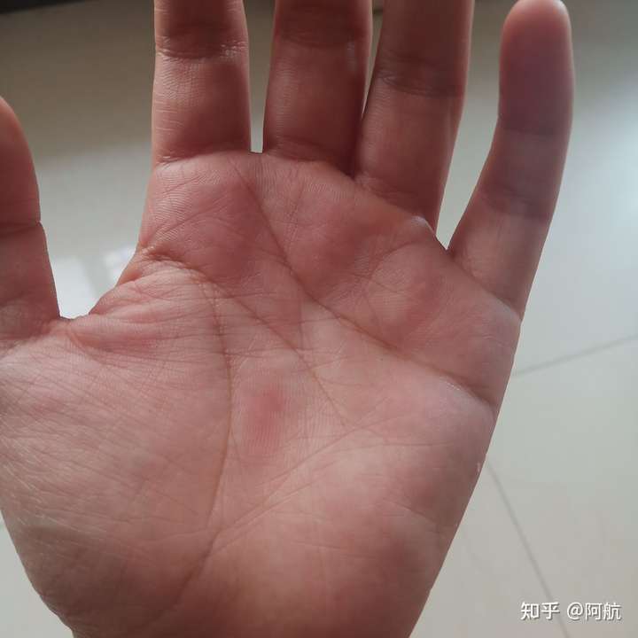 手掌心中间像是一个茧子!困扰了好几年,该怎么解决呢?