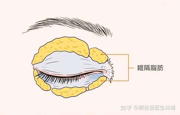 2,肌肉型肿泡眼