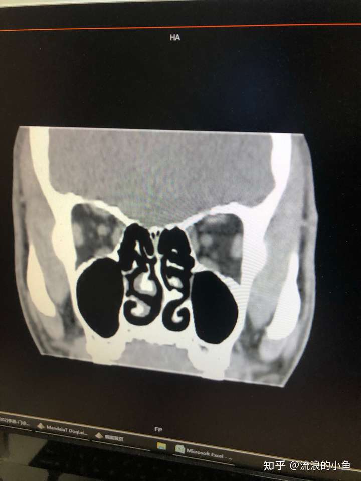 术前检查拍了个鼻镜,做了个鼻部ct,还有一些其他杂七杂八的检查.