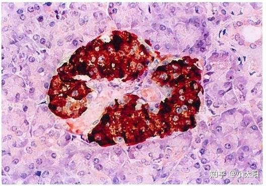 正常胰岛β细胞光镜图(分泌胰岛素的β细胞被染成棕色)