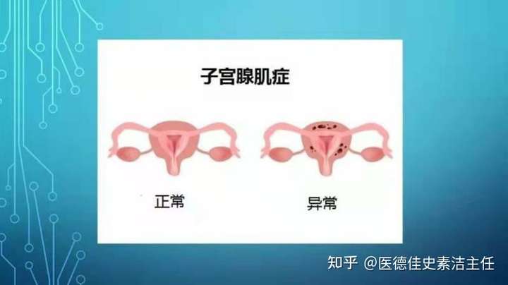 是什么原因导致子宫腺肌症生育困难呢?