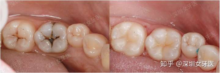 补大牙蛀牙需要多少钱?