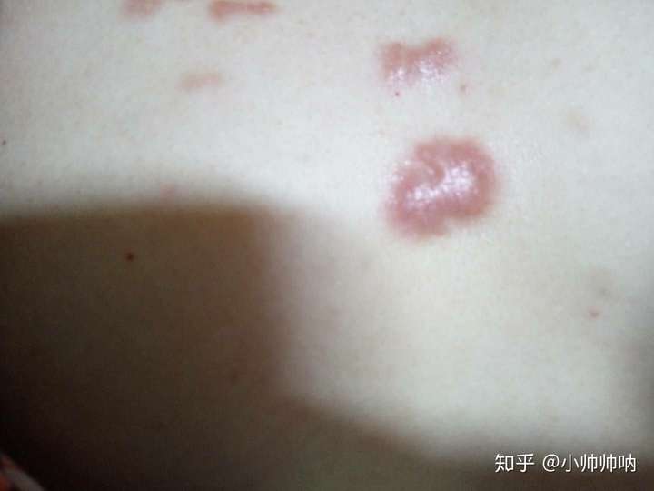 得了疤痕疙瘩是不是这辈子就完了?