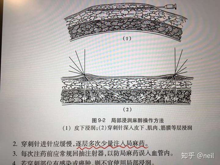 应该是说逐层浸润麻醉