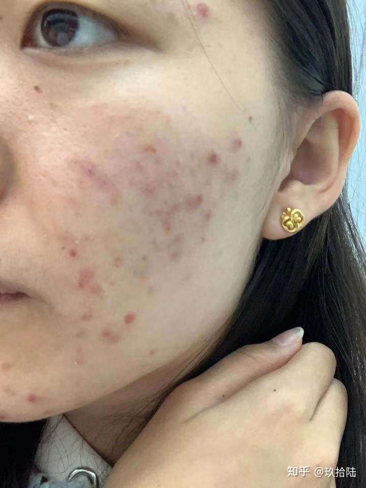 脸上一直反复长闭口的原因是什么?