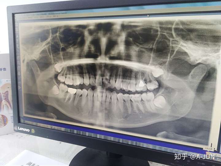 一口龋齿是什么样的体验?