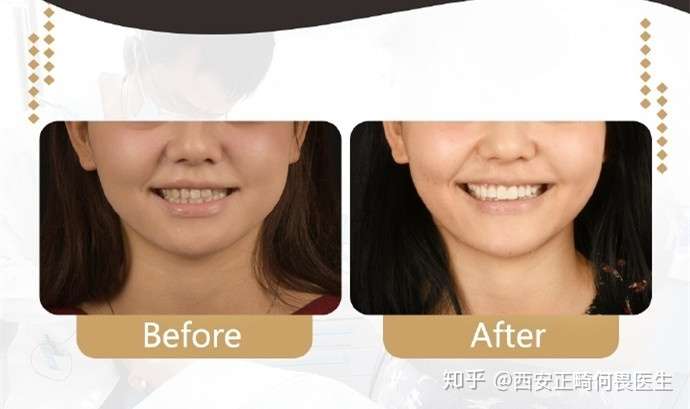 西安牙齿矫正牙齿不齐牙弓不对称正畸案例