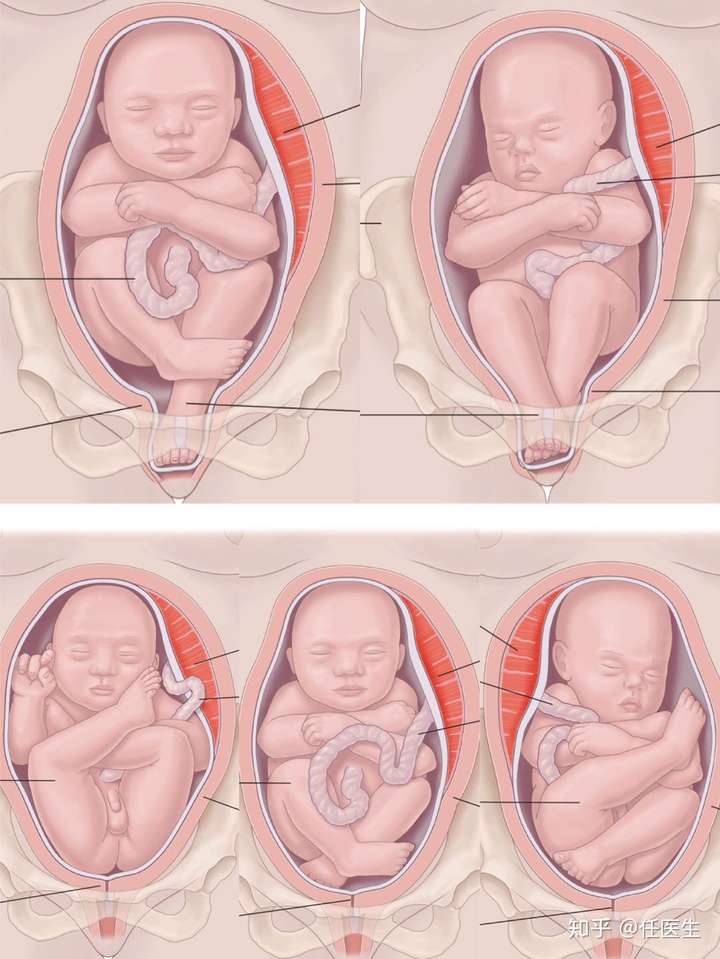 臀位符合以下条件可阴道分娩:骨盆正常;估计胎儿体重≤3500g;单臀或全