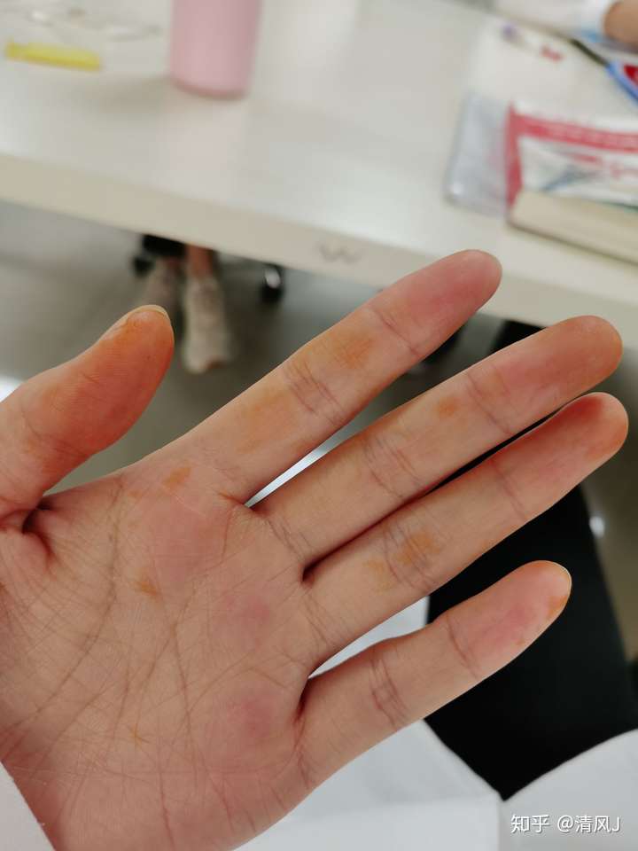 一觉醒来手上有铁锈一般的黄色块洗不掉?