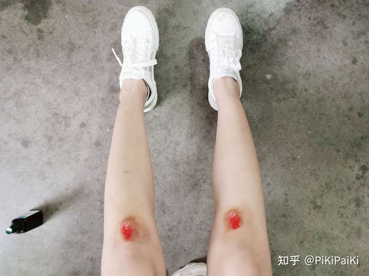 成年人可能同时摔伤两个膝盖么?