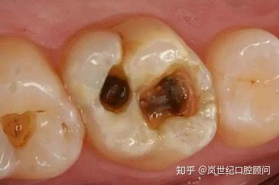 可见儿童出现蛀牙的问题已经十分常见,那么乳牙龋齿的话会影响恒牙吗?