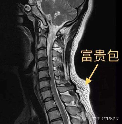 颈椎富贵包和富贵没有关系都说针灸可以消除具体治疗是什么