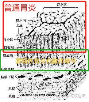 慢性萎缩性胃炎,是以胃粘膜固有腺萎缩(数量减少,功能减低)为其突出