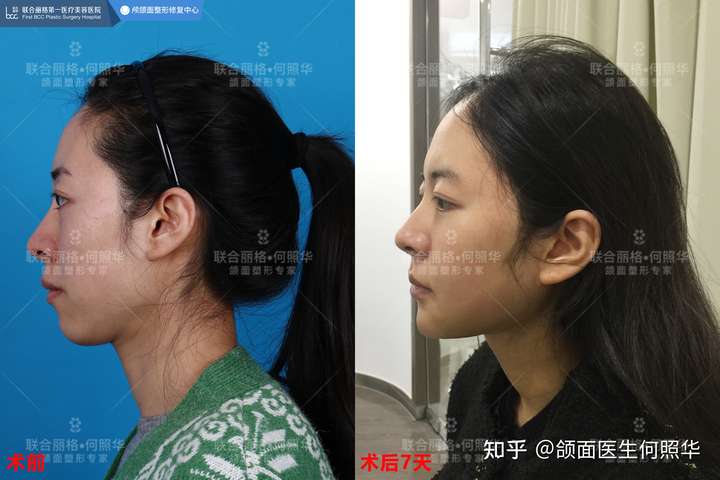下巴上有一坨肉是下巴后缩吗?