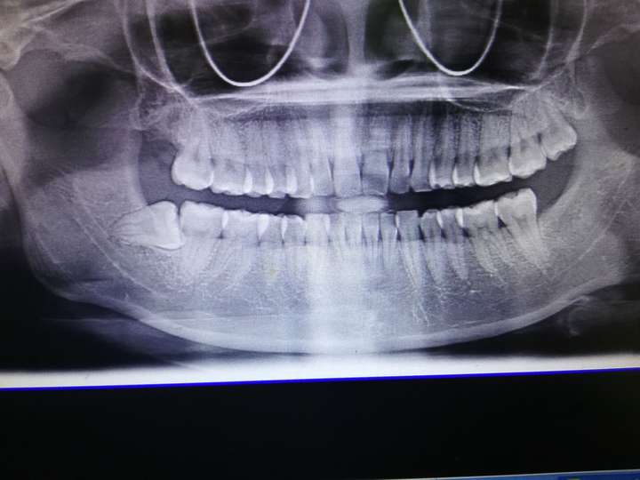 求问如图下边这两颗智齿,都是阻生齿,的拔牙难度?