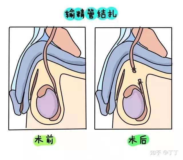 男人结扎,为何那么令人难以接受?