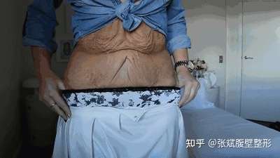 两年减重300斤减重后皮肤松弛却成困扰
