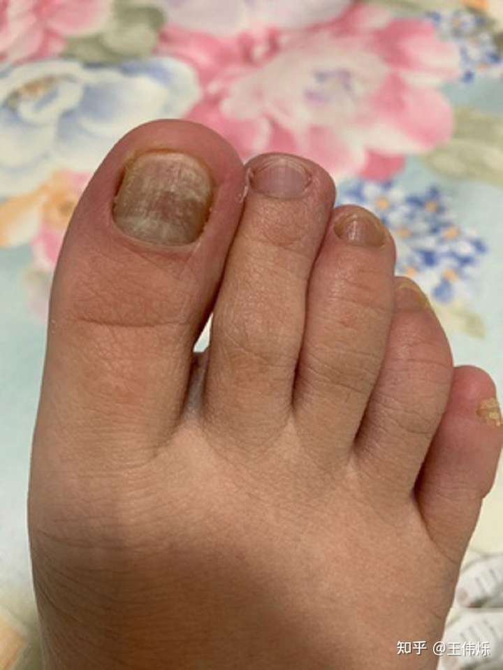 请问灰指甲的饮食要注意哪些(请问灰指甲的饮食要注意哪些问题)