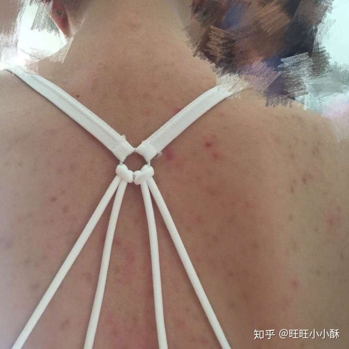 女生后背长痘痘有痘印怎么回事 怎么办?