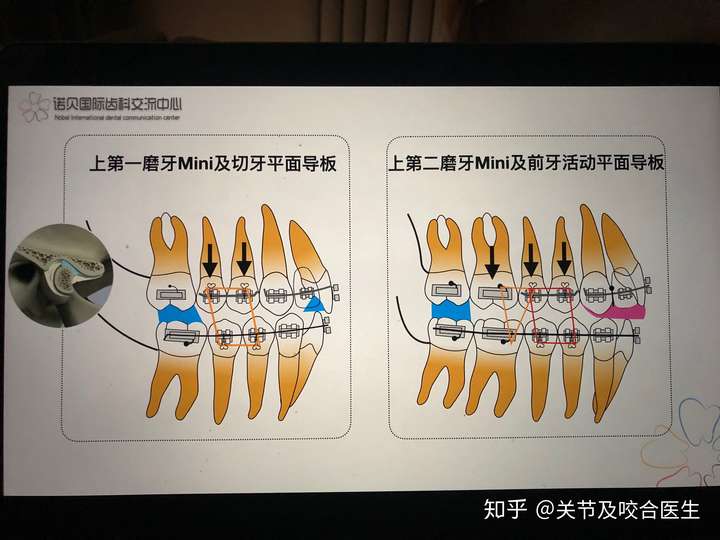 深覆合做矫正都要带平导吗