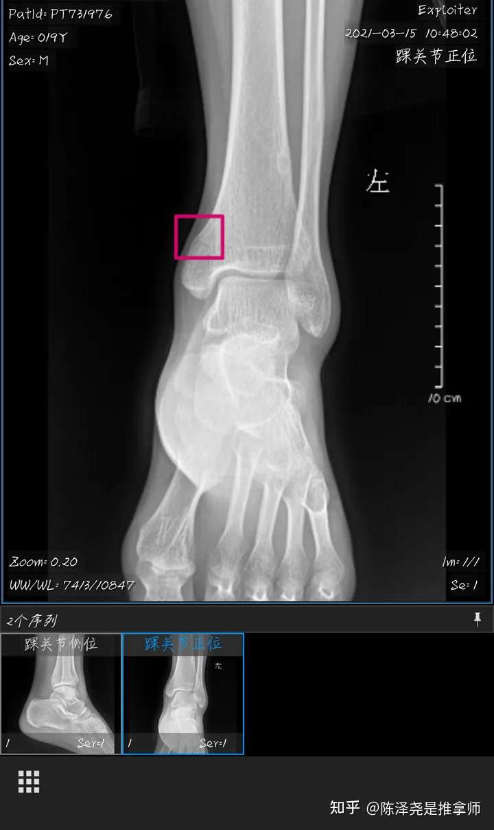 我这样是哪里可以给我圈一下吗,只知道是坐内踝骨折?