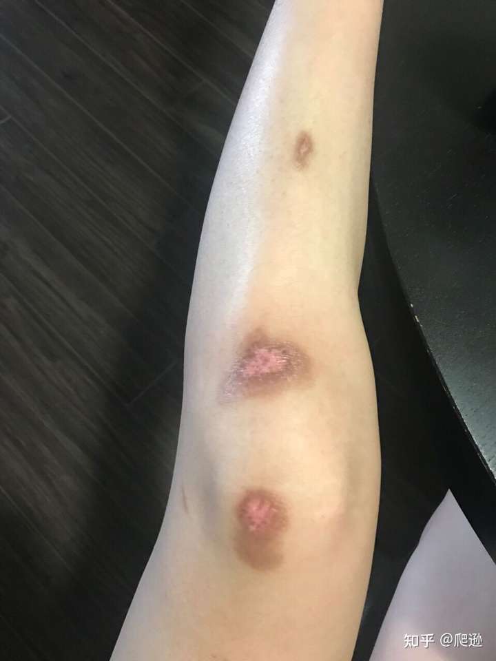 膝盖摔伤,如何去疤痕?