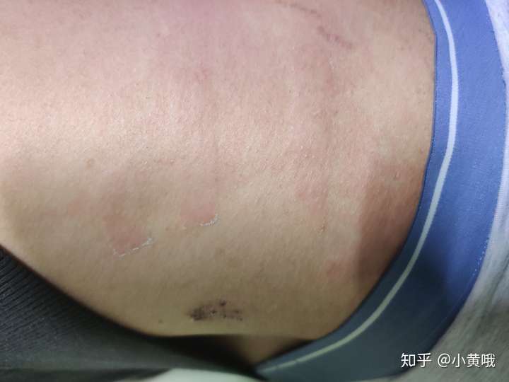 胶带过敏红肿