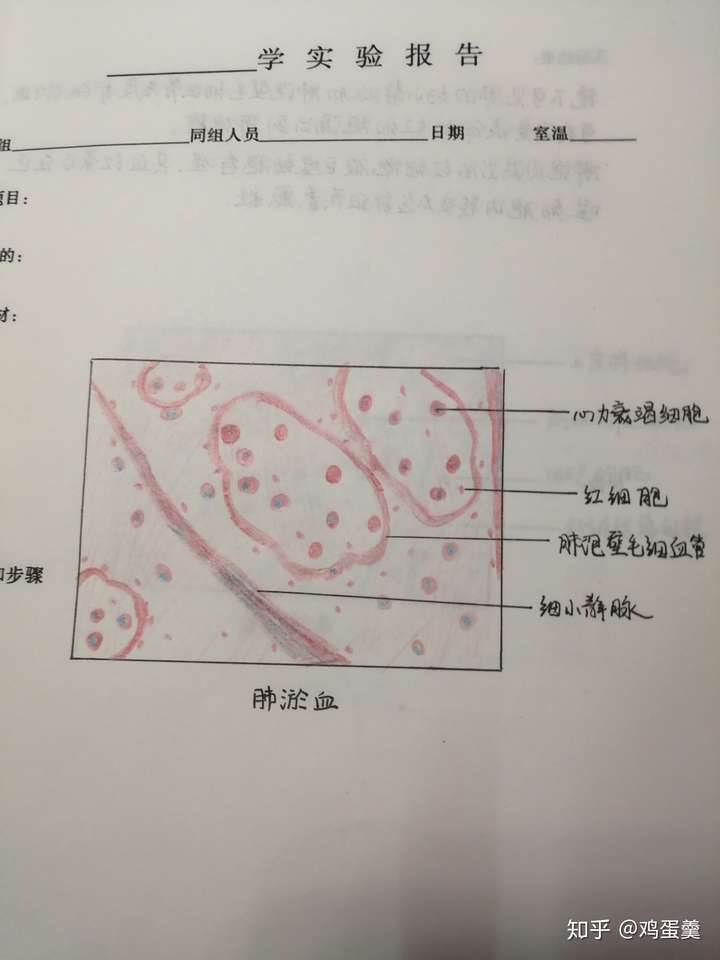 谁有慢性肺淤血高倍镜红蓝手绘图片吗?