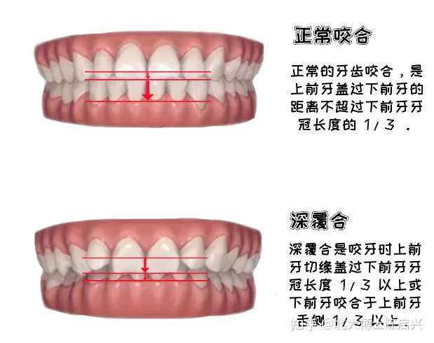 深覆合是什么?有什么危害?