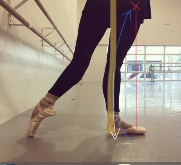 芭蕾舞演员为何都有膝超伸?如何避免?
