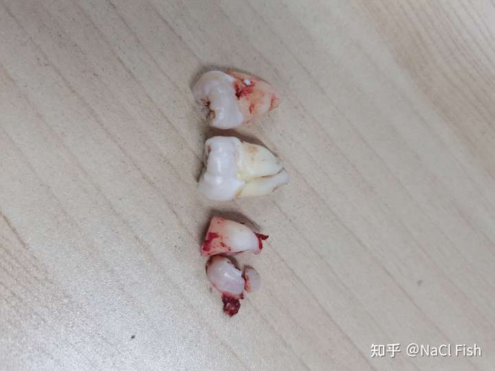 一次性拔了四颗智齿缝针了第三天已经完全不疼了可以吃泡面吗太饿了