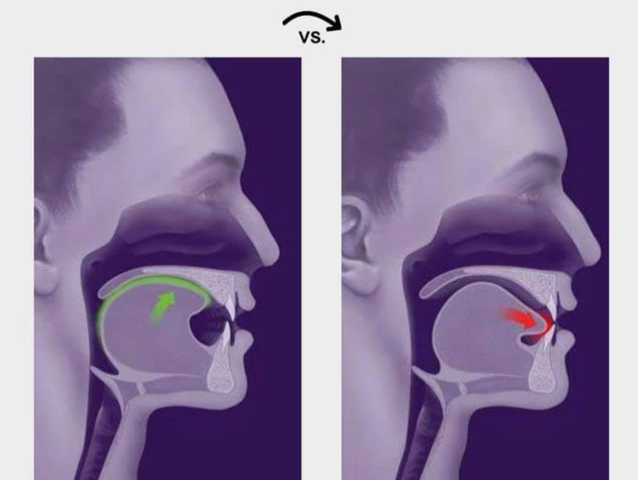 左图鼻呼吸(舌头顶住上腭),右侧张嘴呼吸(舌头放在口腔低位位置)
