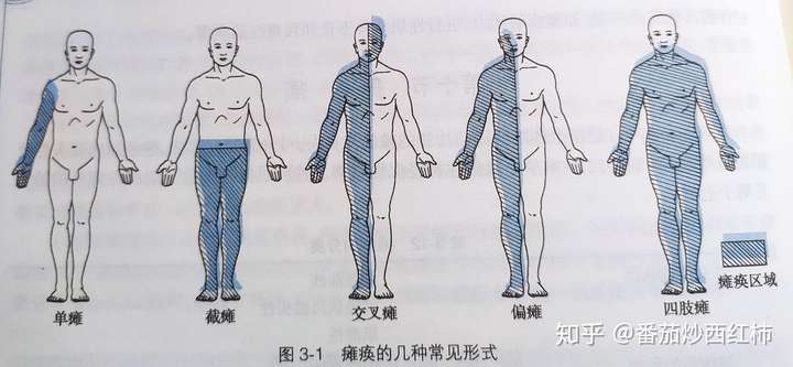 按瘫痪的分布可分为:单瘫,偏瘫,交叉瘫,截瘫,四肢瘫.