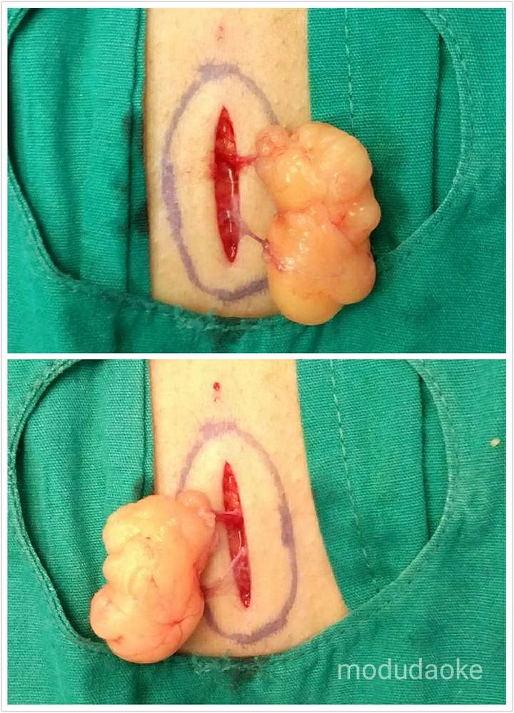 脂肪瘤到底做手术好还是留着无所谓