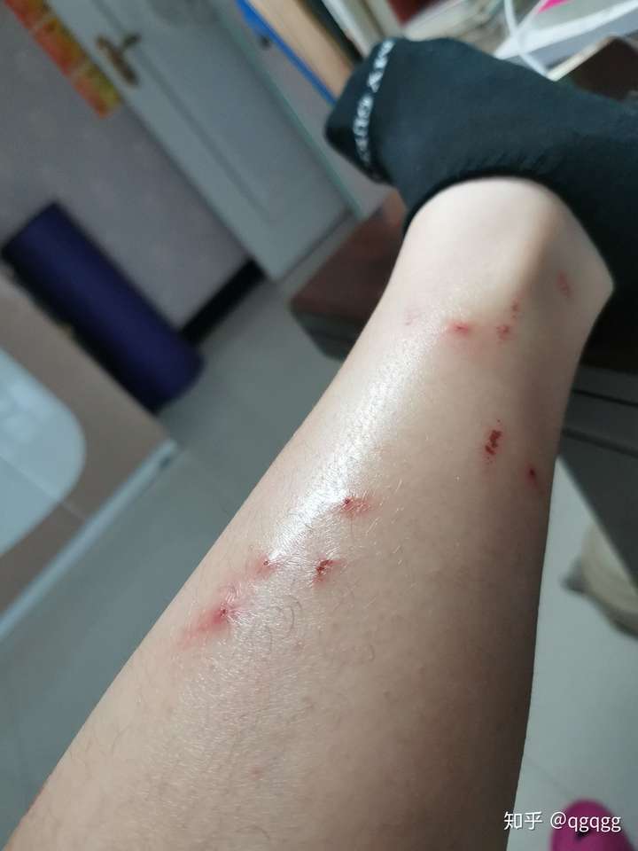 被跳蚤咬的全身都是包是什么样的感受!