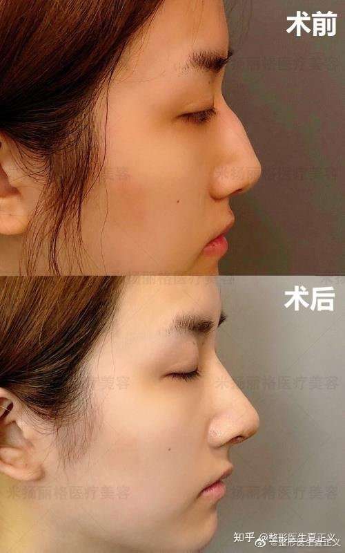 小驼峰鼻,给人的辨识度非常明显.经过隆鼻手术之后,线条更加流程.
