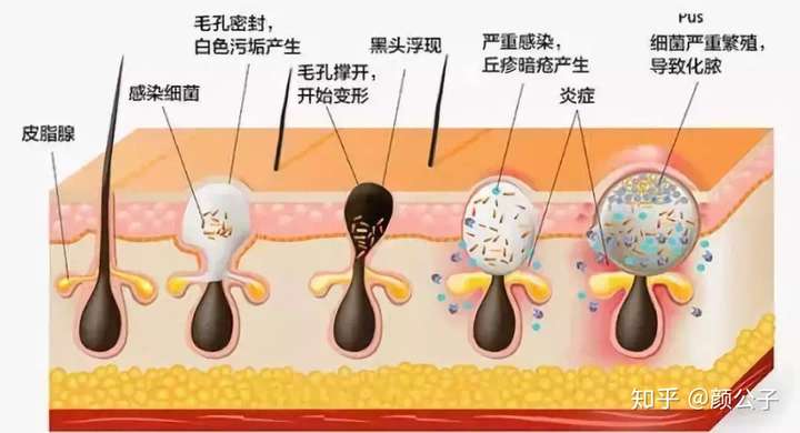 肌肤清洁不到位,脸上太多的角质,油脂无法排出, 不管你敷多少张面膜都