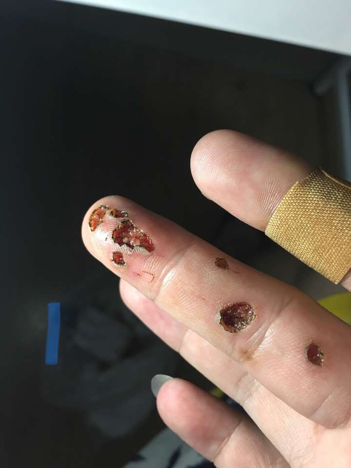 治疗手指上的寻常疣鱼鳞痣有什么办法或者药物
