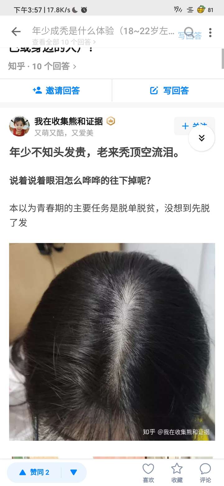 女生秃顶是怎样一种体验?