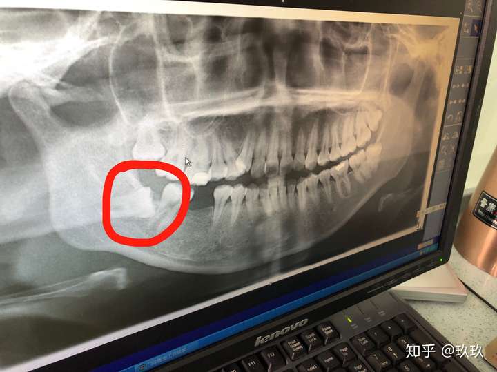 拔智齿有多痛?