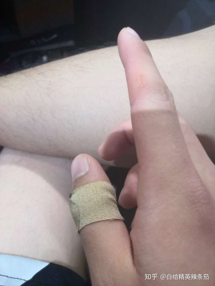 打羽毛球,右手握拍,右手中指指缝靠近无名指侧总流血