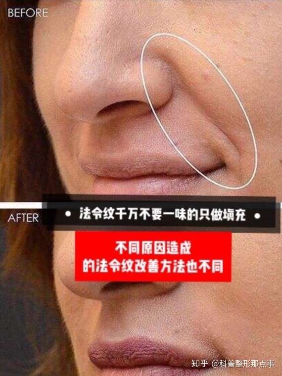 脸部下垂!法令纹明显!还有救吗?