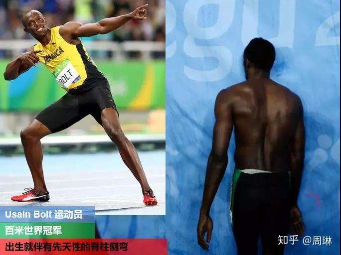 世界短跑冠军,尤赛恩 博尔特就是先天性脊柱侧弯,连牙买加这种国家