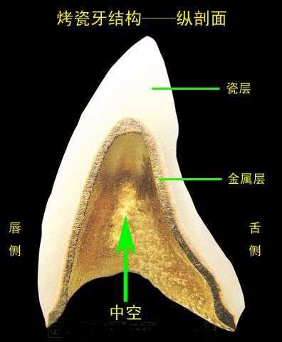 烤瓷牙结构示意图    资料来源:公开资料