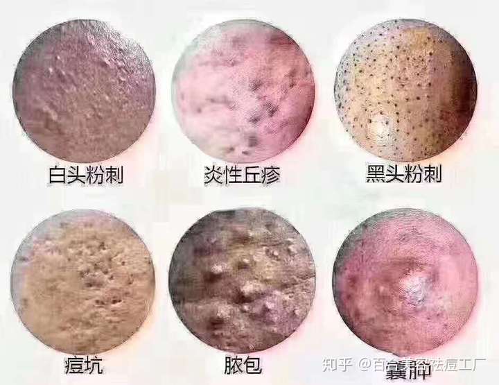 痘痘的类型有很多种:黑头粉刺,白头粉刺,闭合型粉刺,囊肿,丘疹