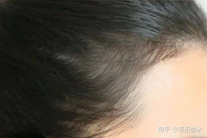 这是前几天拍的,我的头发有它自己的想法,哈哈~ 脱发成功治愈真的